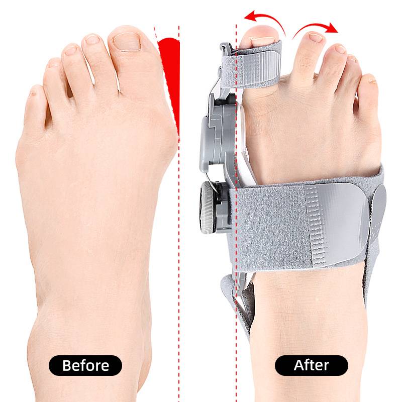 Correttore Alluce Valgo in Silicone Spaziatore per Dita per Comfort e Allineamento-VISOTKI