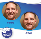 Faccetta Smile in Resina Composita - Design Naturale per Estetica Dentale - Inclusi Superiori e Inferiori-VISOTKI