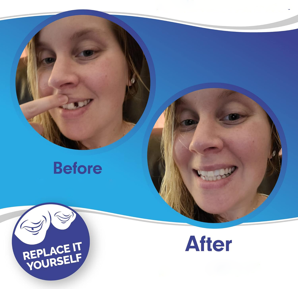 Faccetta Smile in Resina Composita - Design Naturale per Estetica Dentale - Inclusi Superiori e Inferiori-VISOTKI
