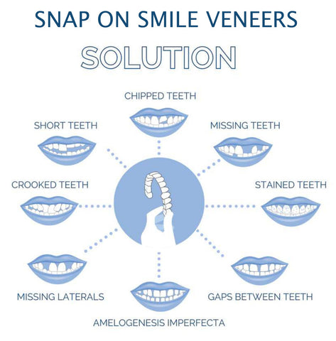 Faccetta Smile in Resina Composita - Design Naturale per Estetica Dentale - Inclusi Superiori e Inferiori-VISOTKI
